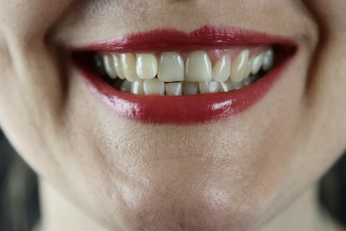 Lees meer over het artikel Hoe verzorg je ontstoken tandvlees?